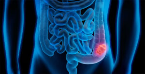 Descubren cómo prevenir el dolor neuropático asociado a la quimioterapia en el cáncer de colon.